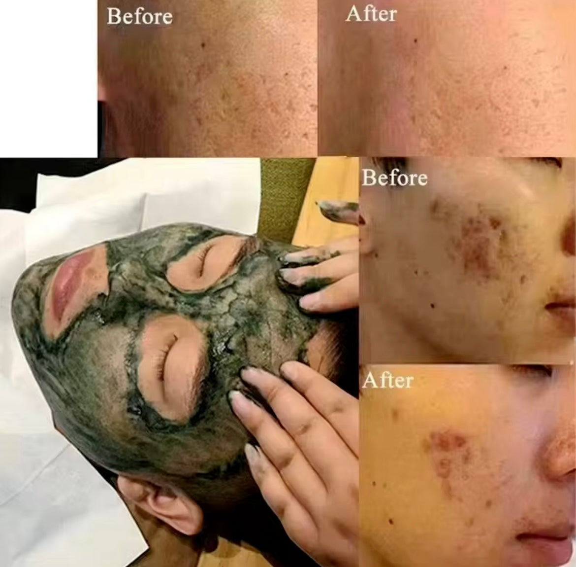 Spongilla Tech Algae Peel Kit